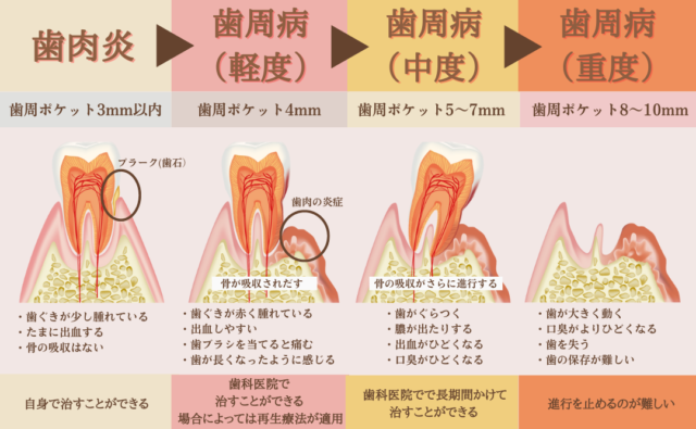 歯周基本治療とは?歯周病は完治するの?放っておくとどうなる? | 豊島区池袋の歯科、歯医者をお探しなら「ムクノキ歯科」