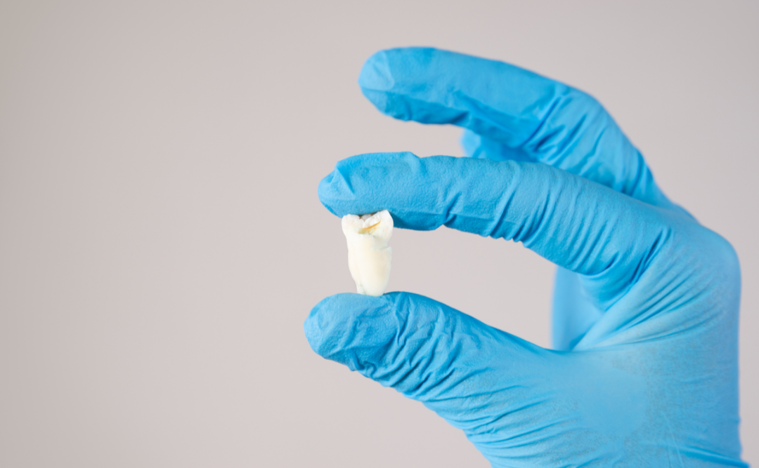 親知らずの抜歯に最適なタイミング｜ムクノキ歯科