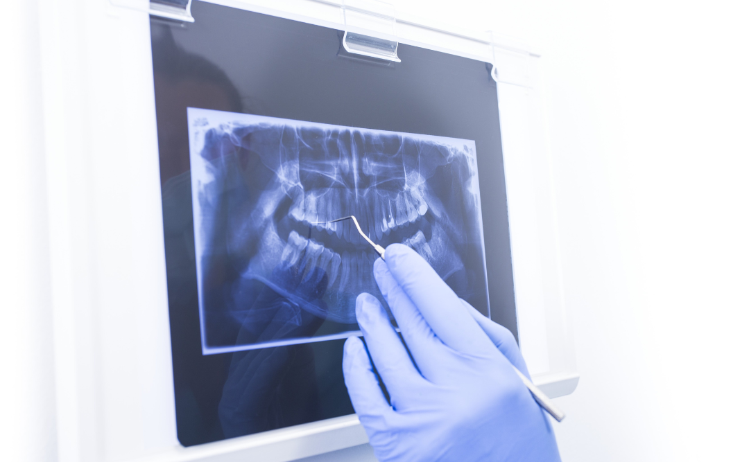 レントゲンで確認｜ムクノキ歯科