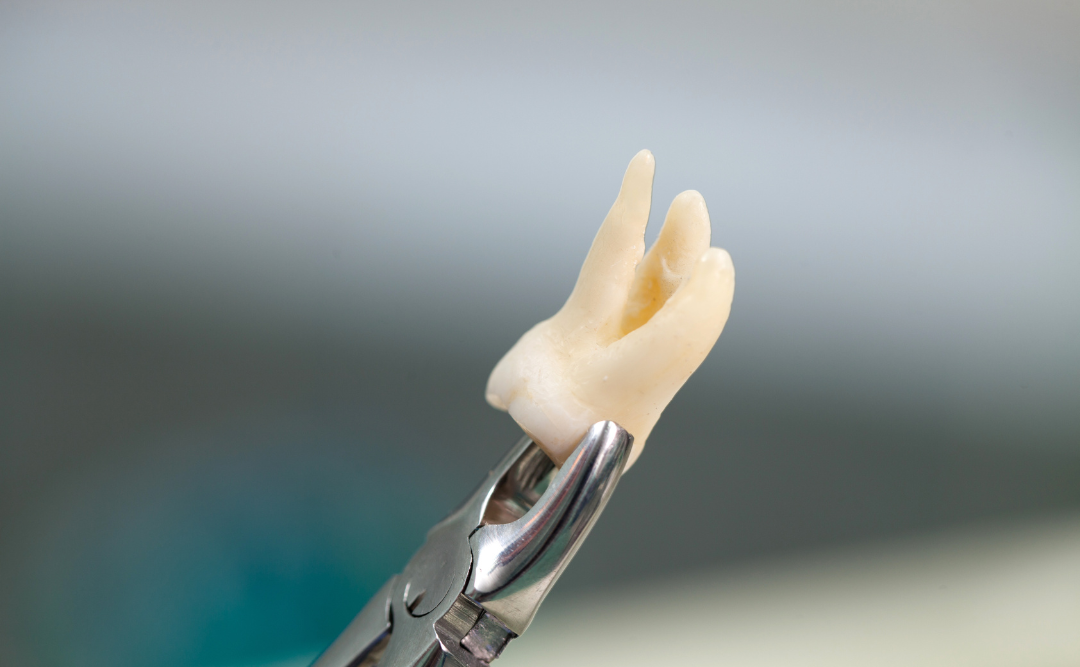 抜歯された歯|ムクノキ歯科