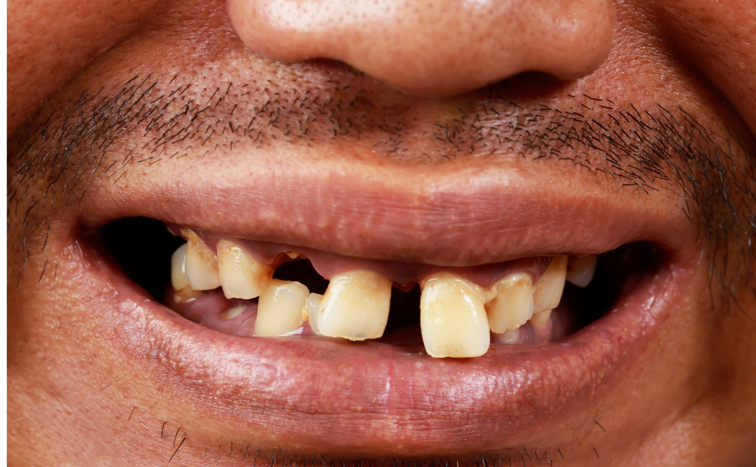 歯周病で歯がグラグラの男性｜ムクノキ歯科