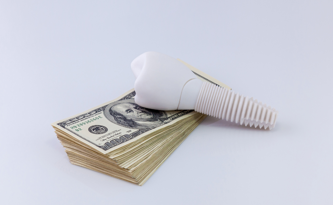 インプラントの費用｜ムクノキ歯科