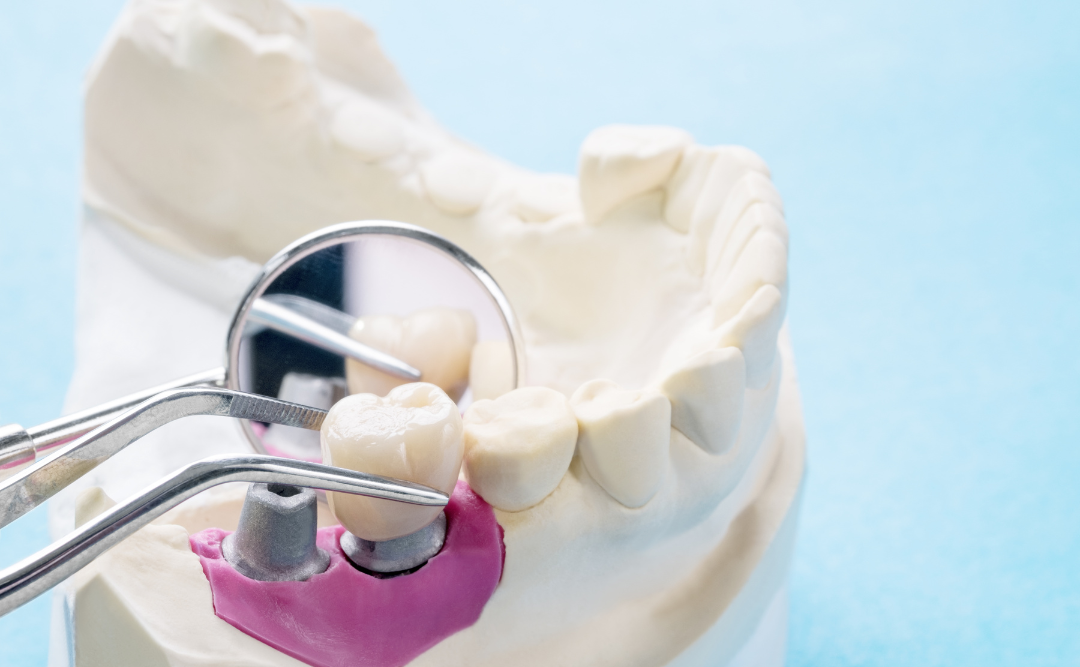 インプラントとその他補綴物との違い｜ムクノキ歯科