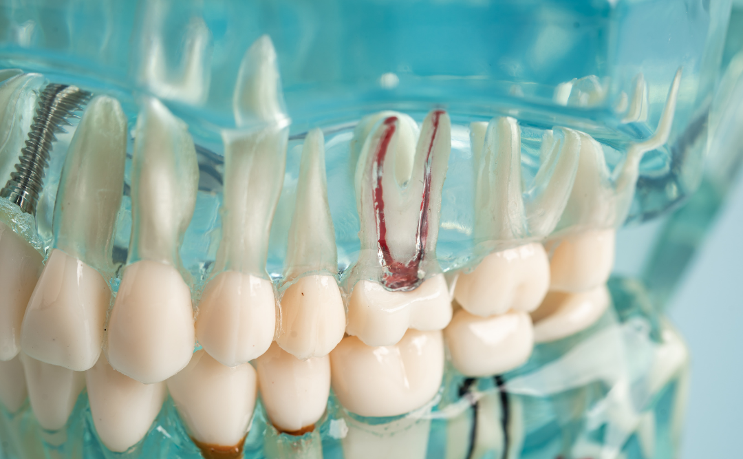 歯性上顎洞炎の治療|ムクノキ歯科