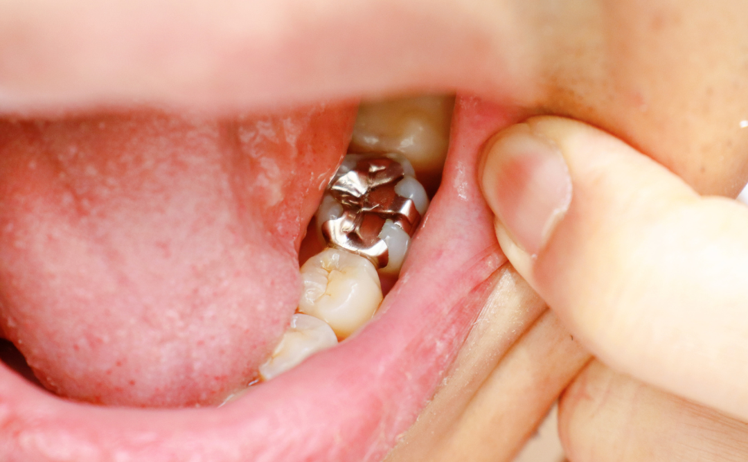 銀歯の入った口内｜ムクノキ歯科