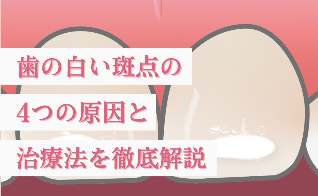 歯の白い斑点(ホワイトスポット)の4つの原因と治療法を徹底解説|ムクノキ歯科