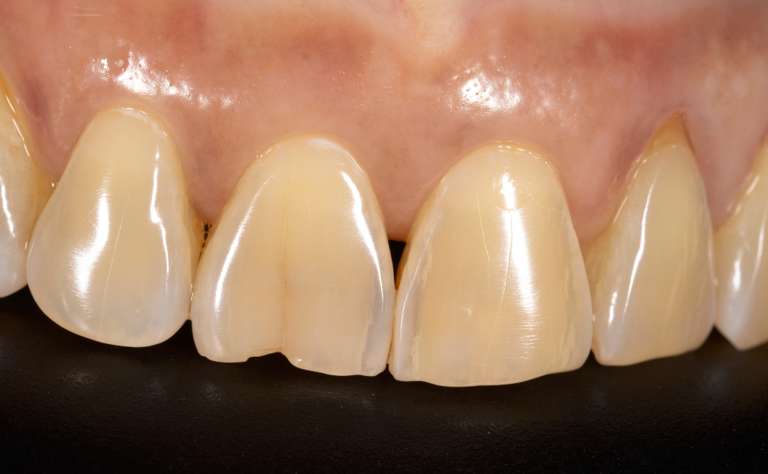 ヒビの入った前歯｜ムクノキ歯科