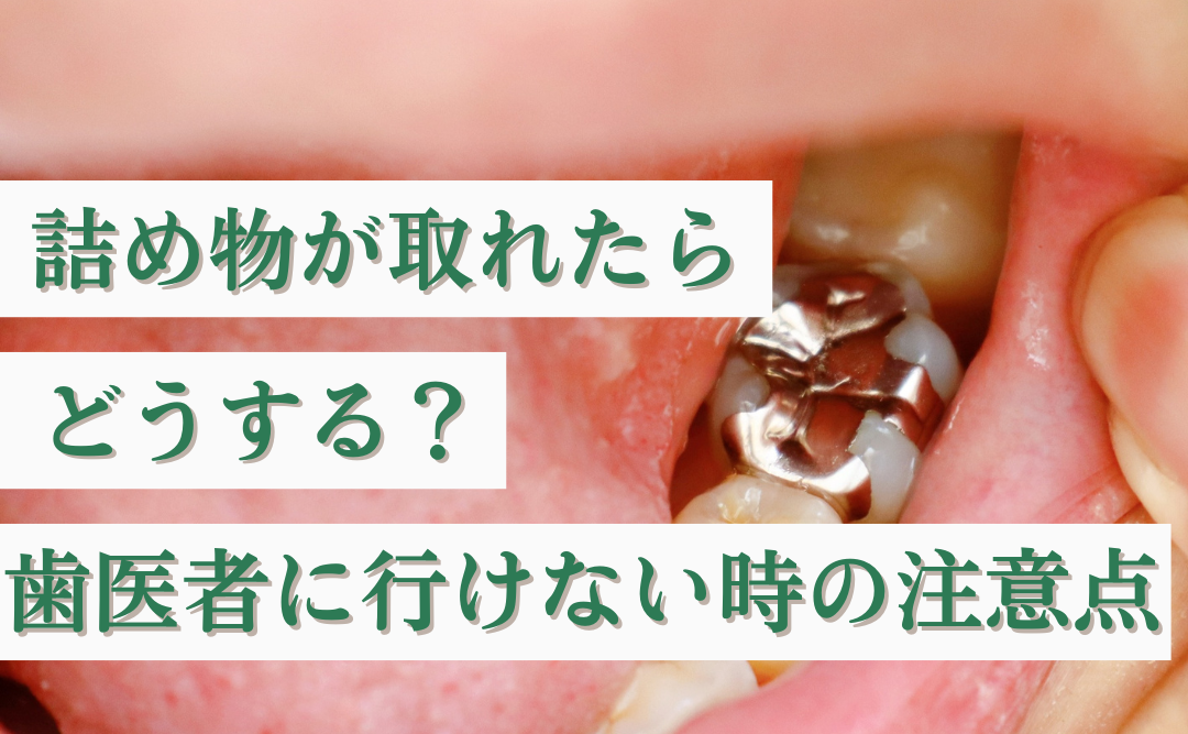 詰め物が取れたらどうする？原因とすぐ歯医者に行けない時の注意点｜ムクノキ歯科