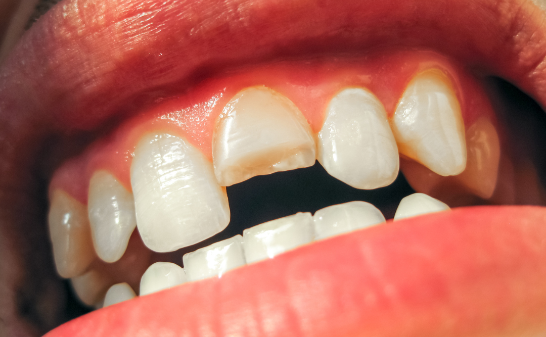 歯が折れた人｜ムクノキ歯科