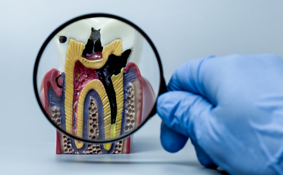 虫歯の模型｜ムクノキ歯科