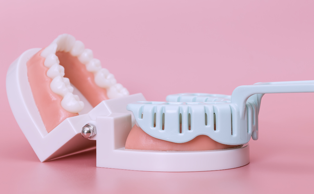 銀歯の型取り｜ムクノキ歯科