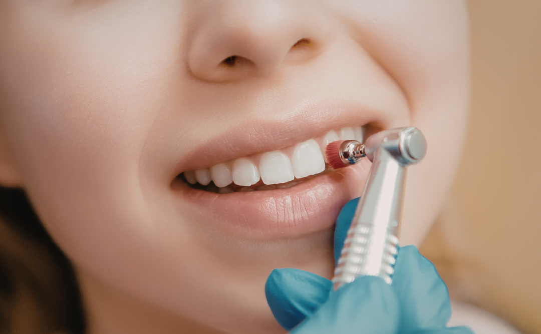 歯のクリーニングを受ける女性｜ムクノキ歯科