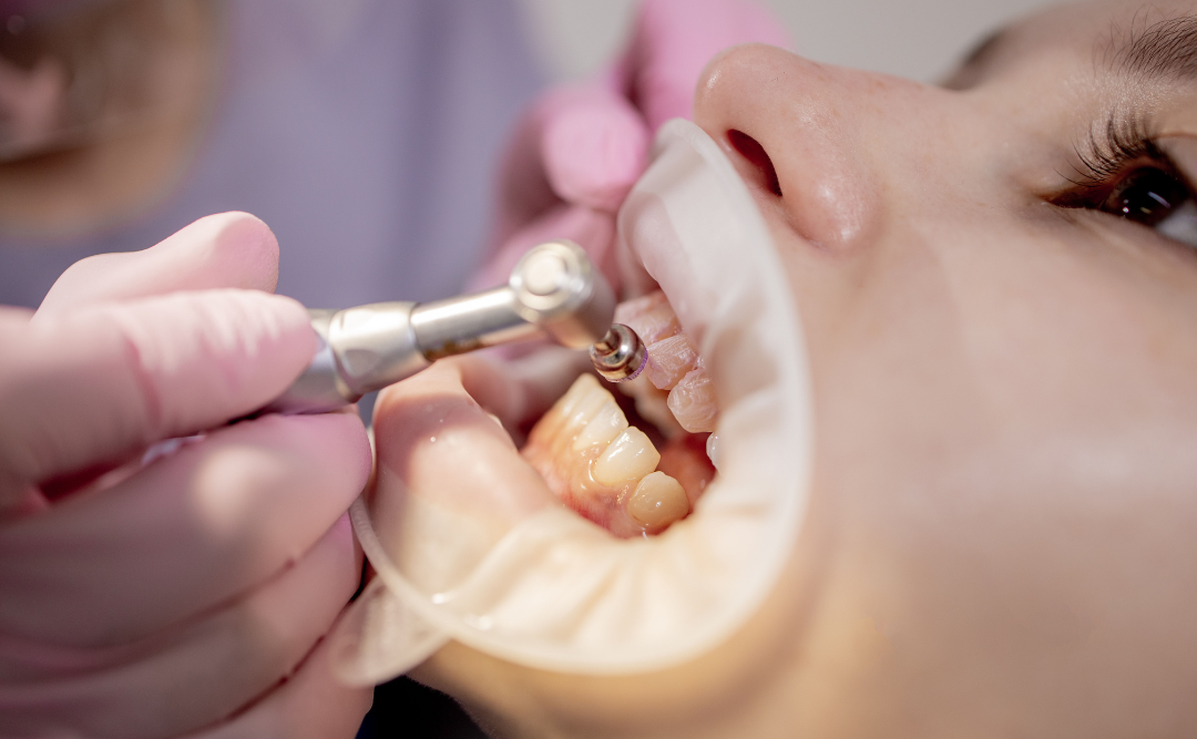 歯のクリーニング中の女性｜ムクノキ歯科