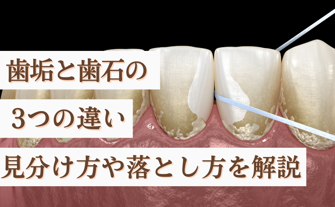歯垢と歯石の違い|見分け方や落とし方をやさしく解説|ムクノキ歯科