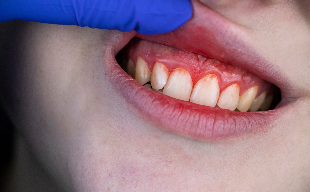 歯茎から出血｜ムクノキ歯科