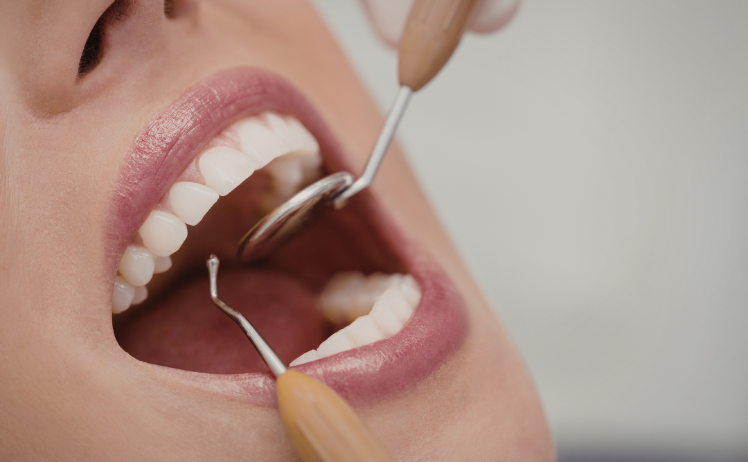 クリーニングを受ける女性｜ムクノキ歯科