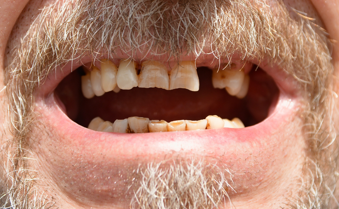 歯が抜けている老人の口|ムクノキ歯科