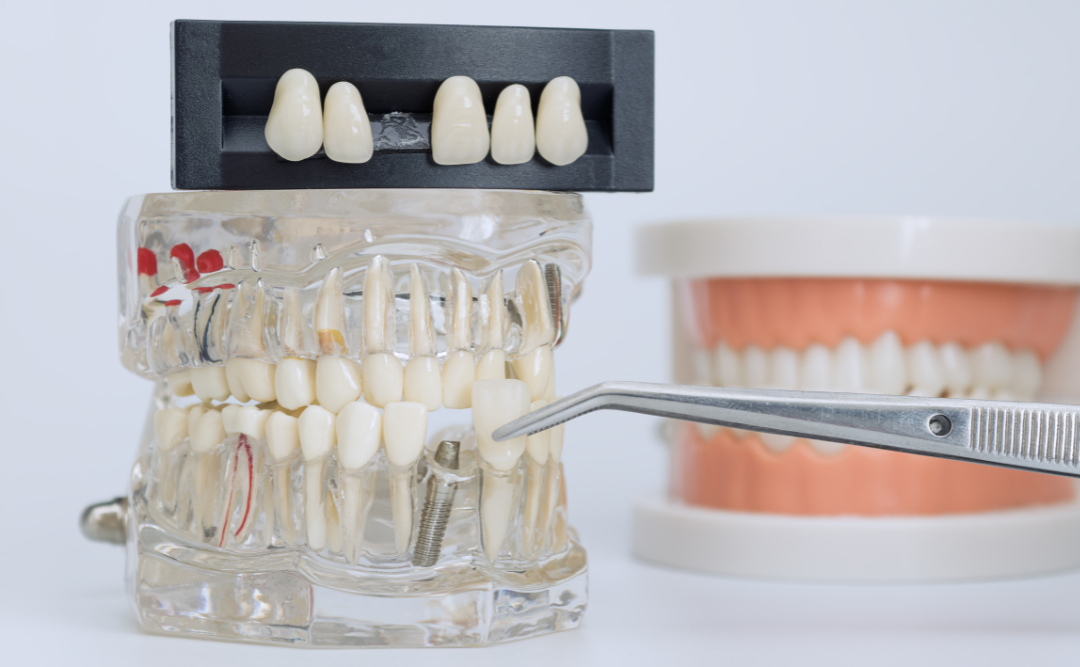 前歯のインプラント｜ムクノキ歯科