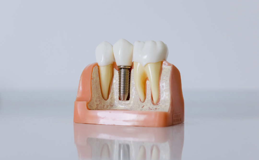 インプラント｜ムクノキ歯科