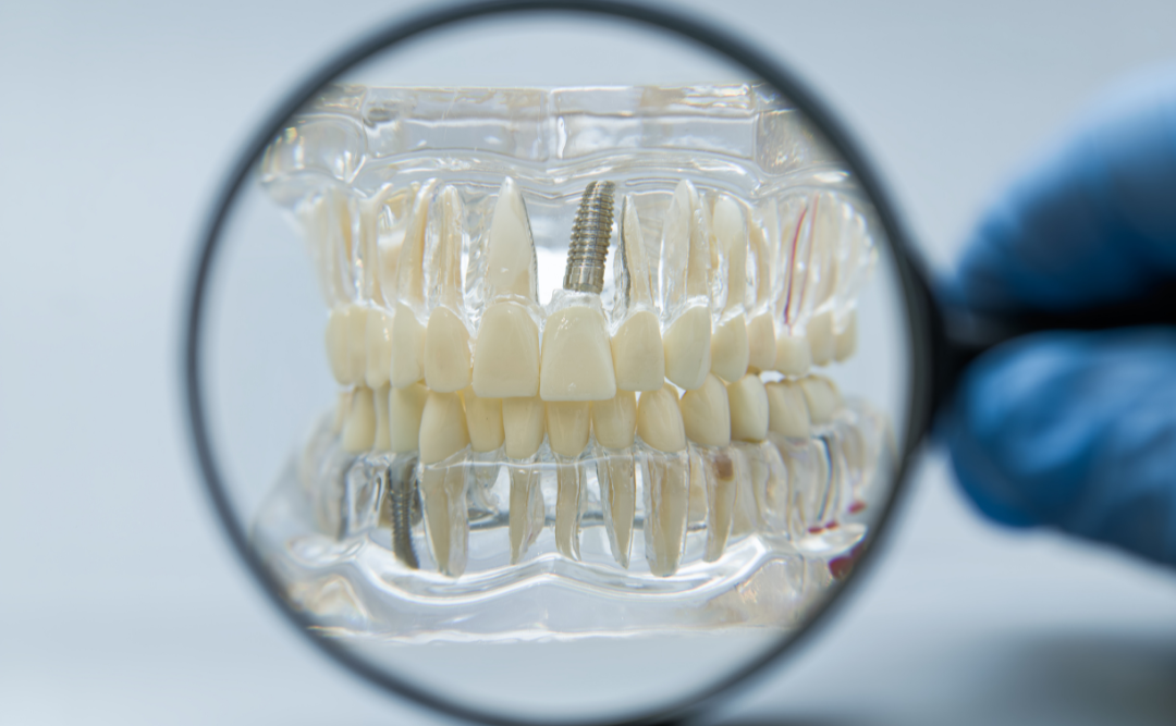 インプラント｜ムクノキ歯科