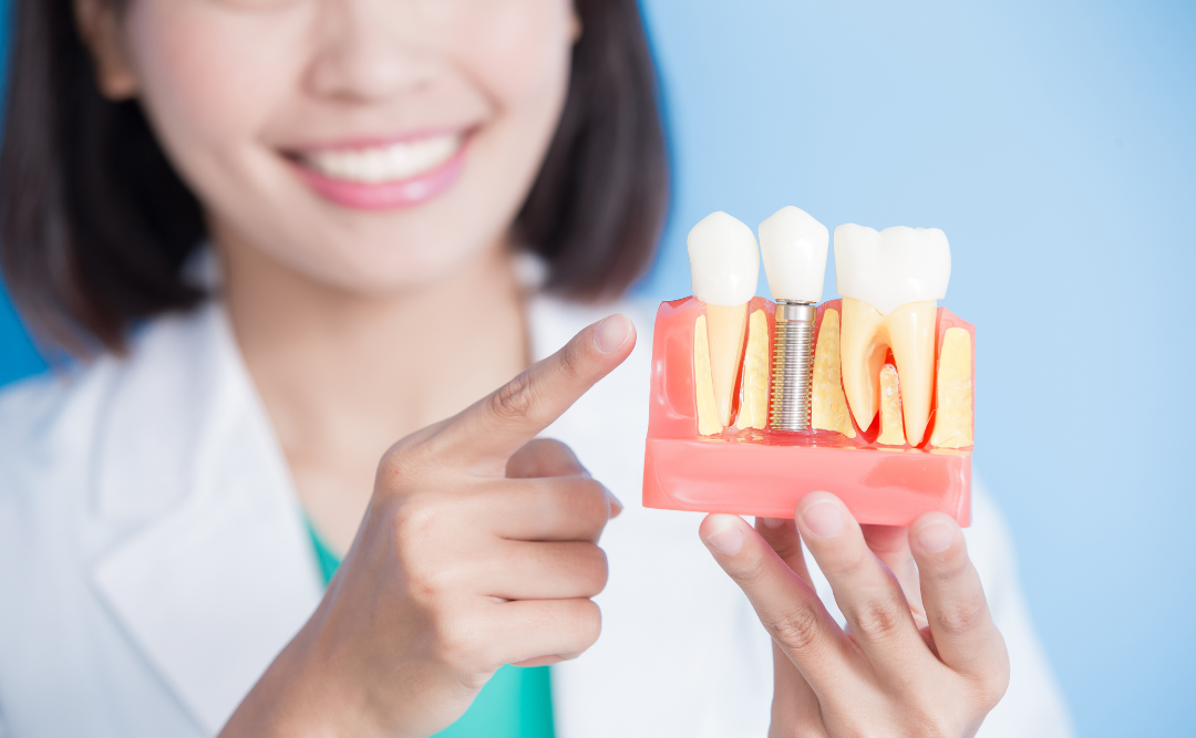 インプラント解説｜ムクノキ歯科