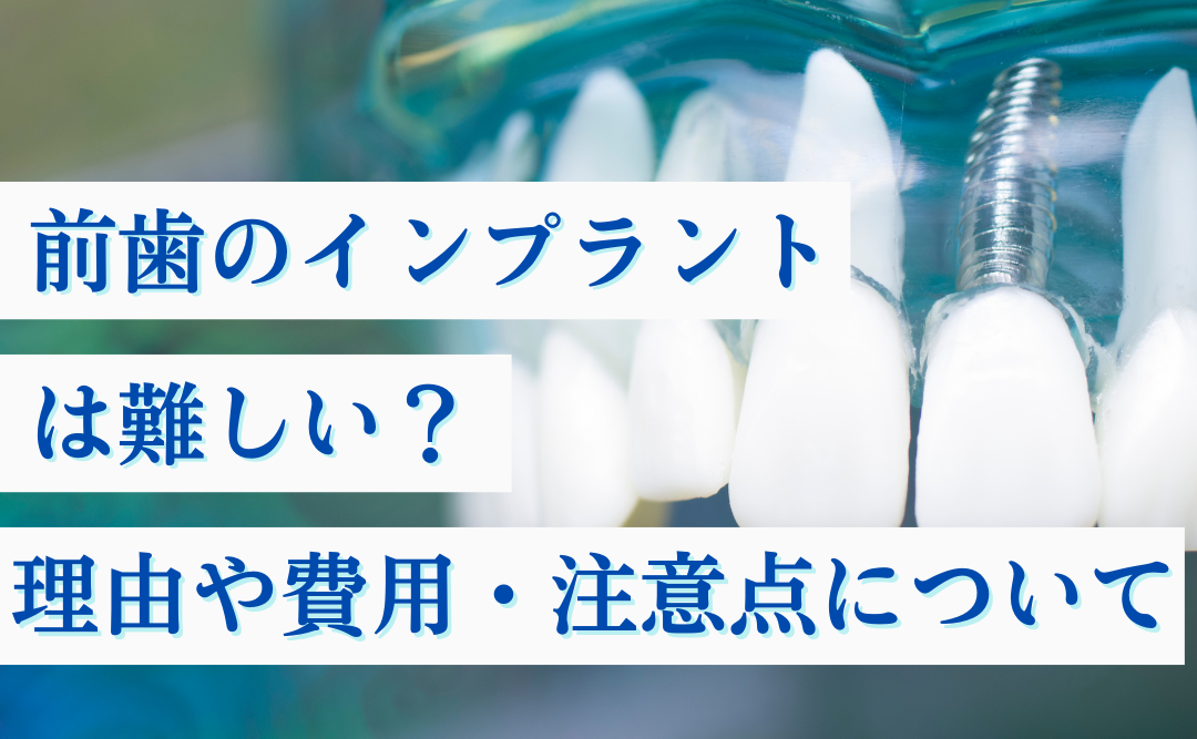 前歯のインプラントは難しい？理由や費用・注意点について解説｜ムクノキ歯科